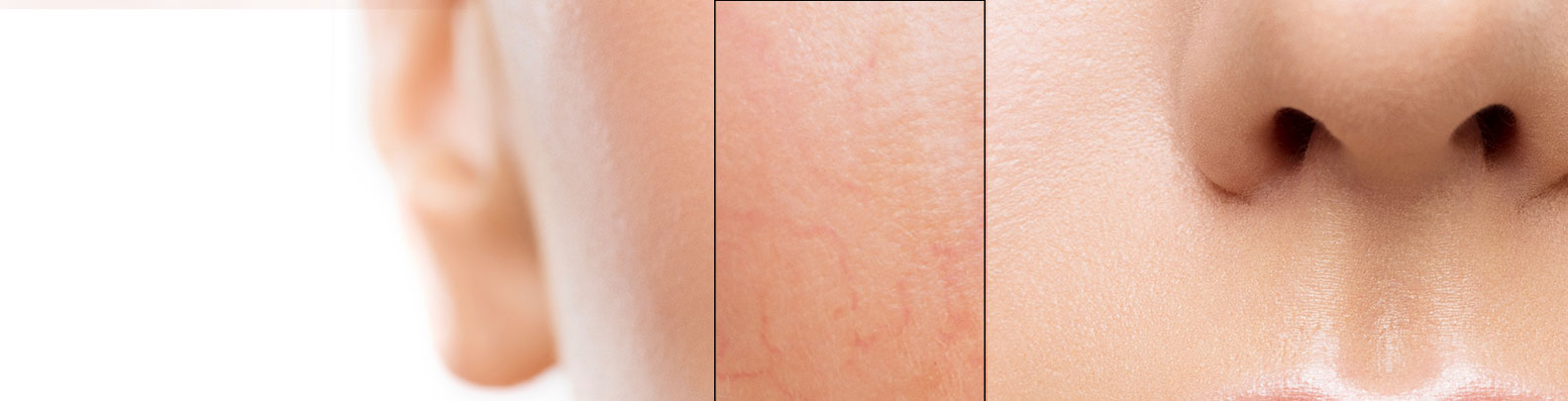 rosacea treatment in cork