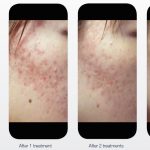 lumenis m22 acne cork
