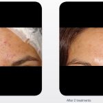 lumenis m22 acne cork