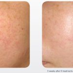 M22 Treatment Rosacea