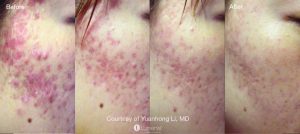 Acne_118