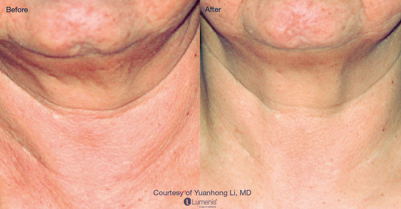 Photorejuvenation_11.jpg
