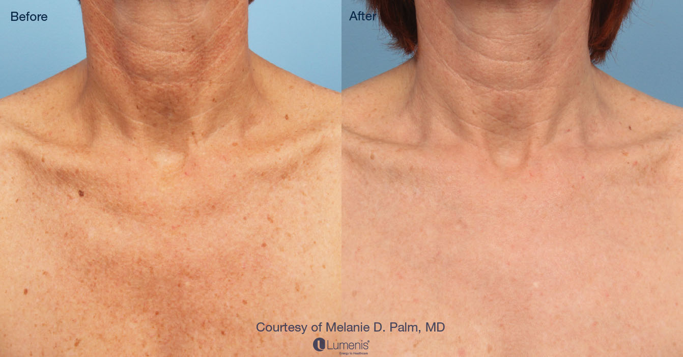 Photorejuvenation_12.jpg