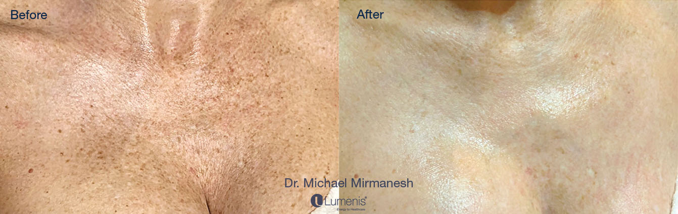 Photorejuvenation_133.jpg