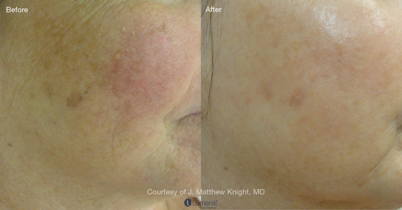 Photorejuvenation_14.jpg