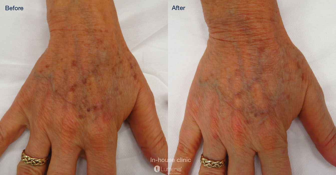 Photorejuvenation_17.jpg
