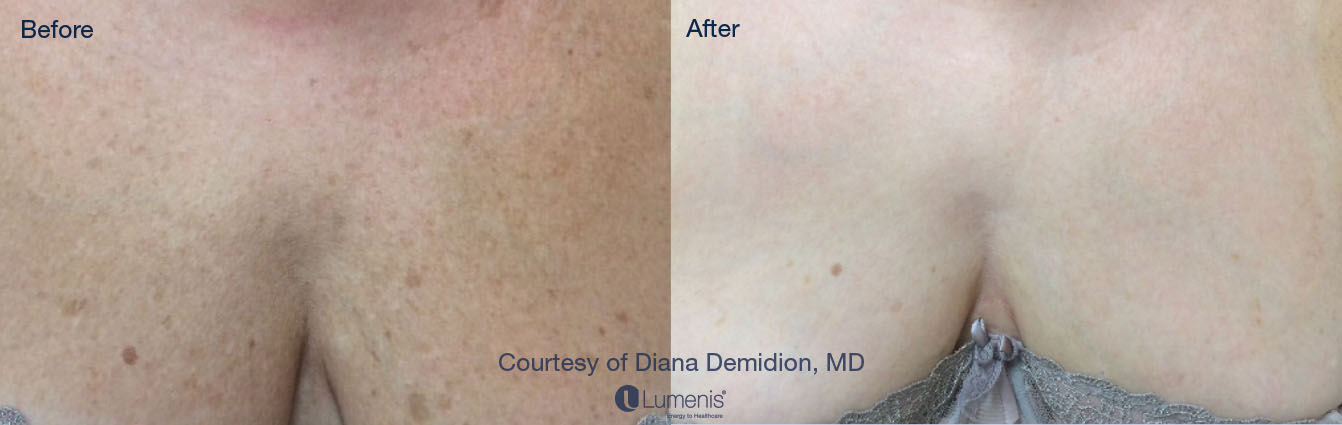 Photorejuvenation_18.jpg