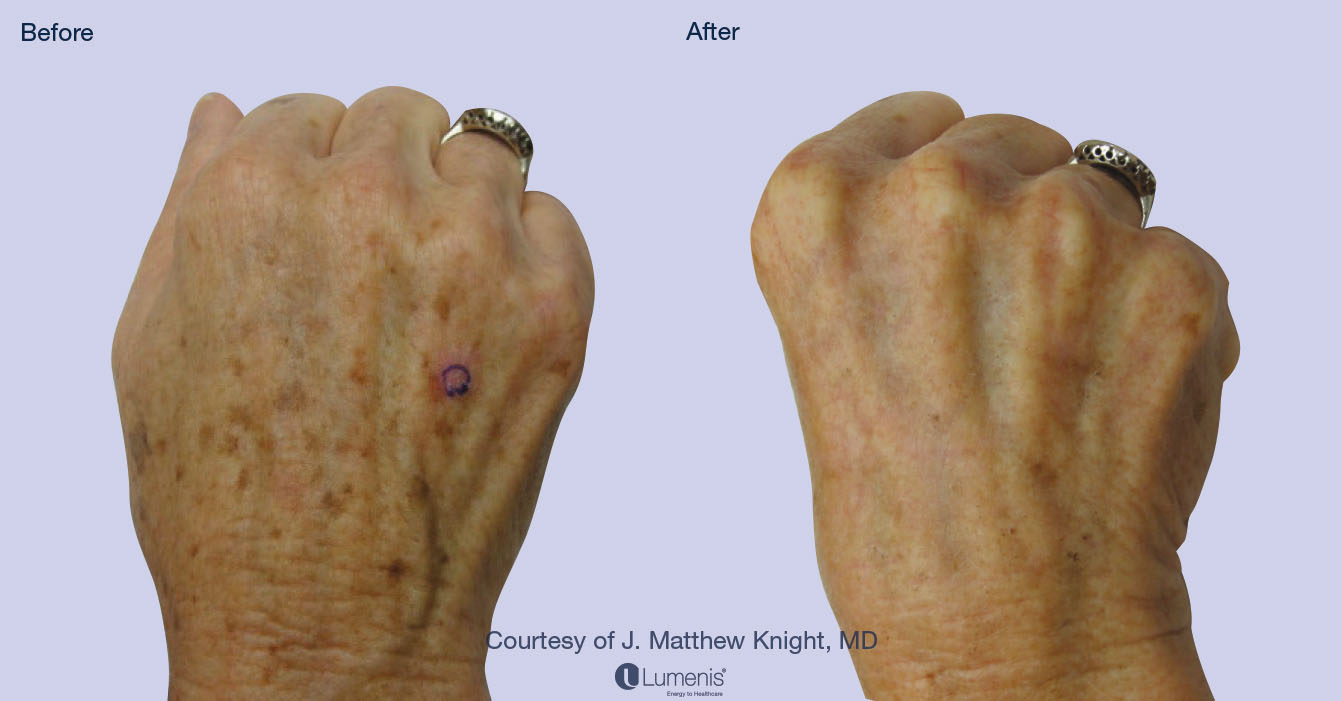 Photorejuvenation_19.jpg