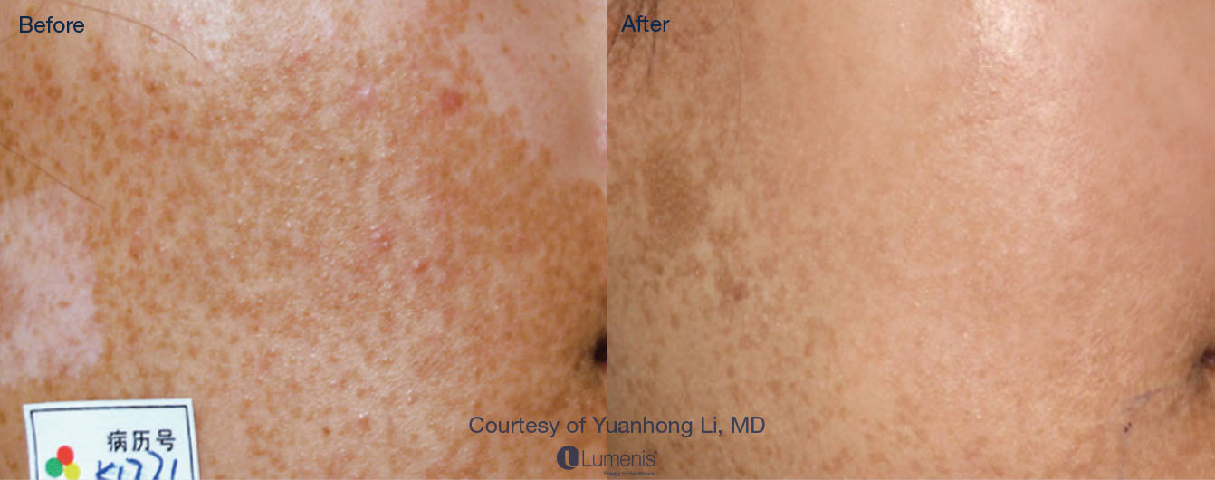 Photorejuvenation_20.jpg