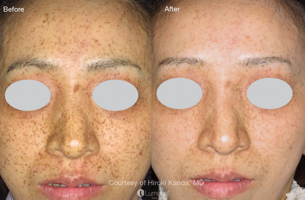 Photorejuvenation_24.jpg
