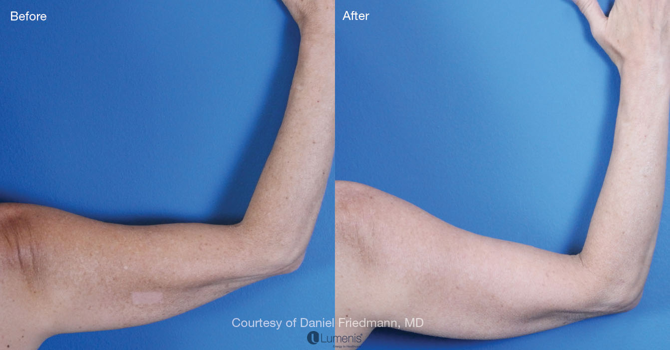 Photorejuvenation_4.jpg