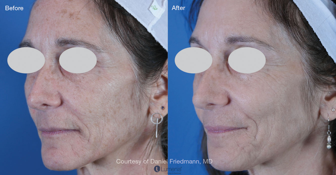 Photorejuvenation_5.jpg