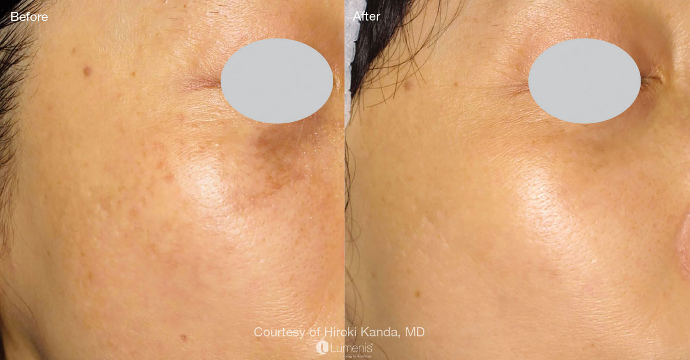 Pigmentation_64.jpg