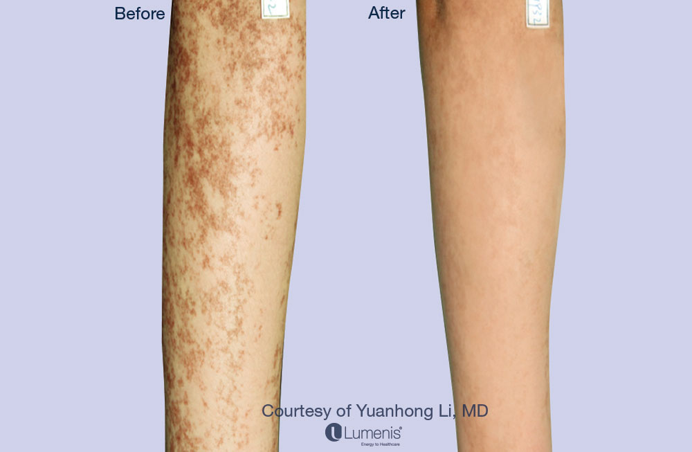Pigmentation_68.jpg